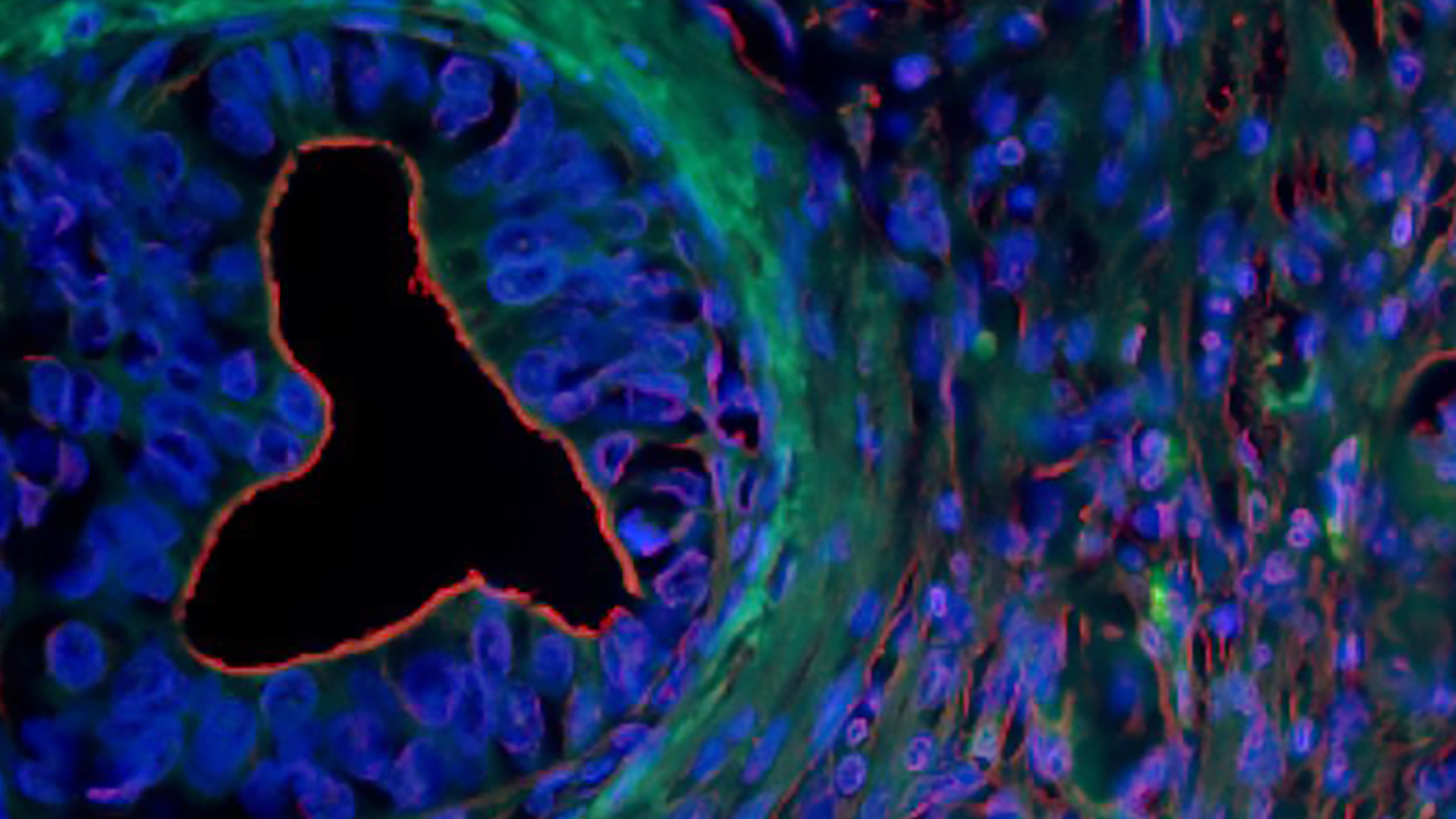 SRI researchers identify a biomarker to target and treat pancreatic cancer